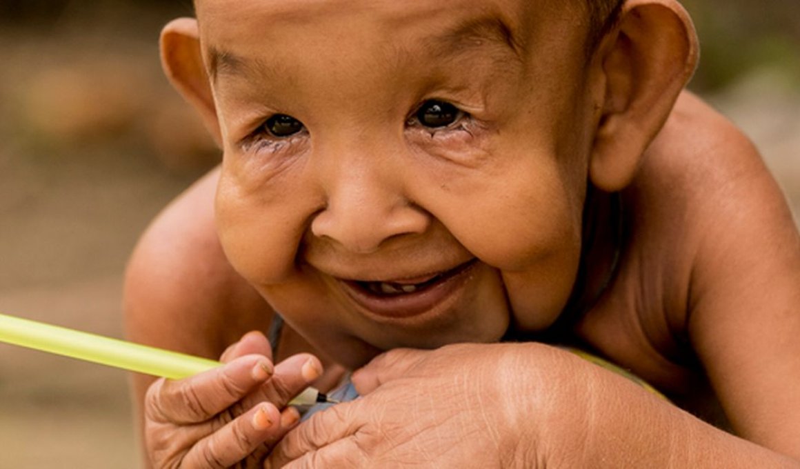 O αληθινός Benjamin Button